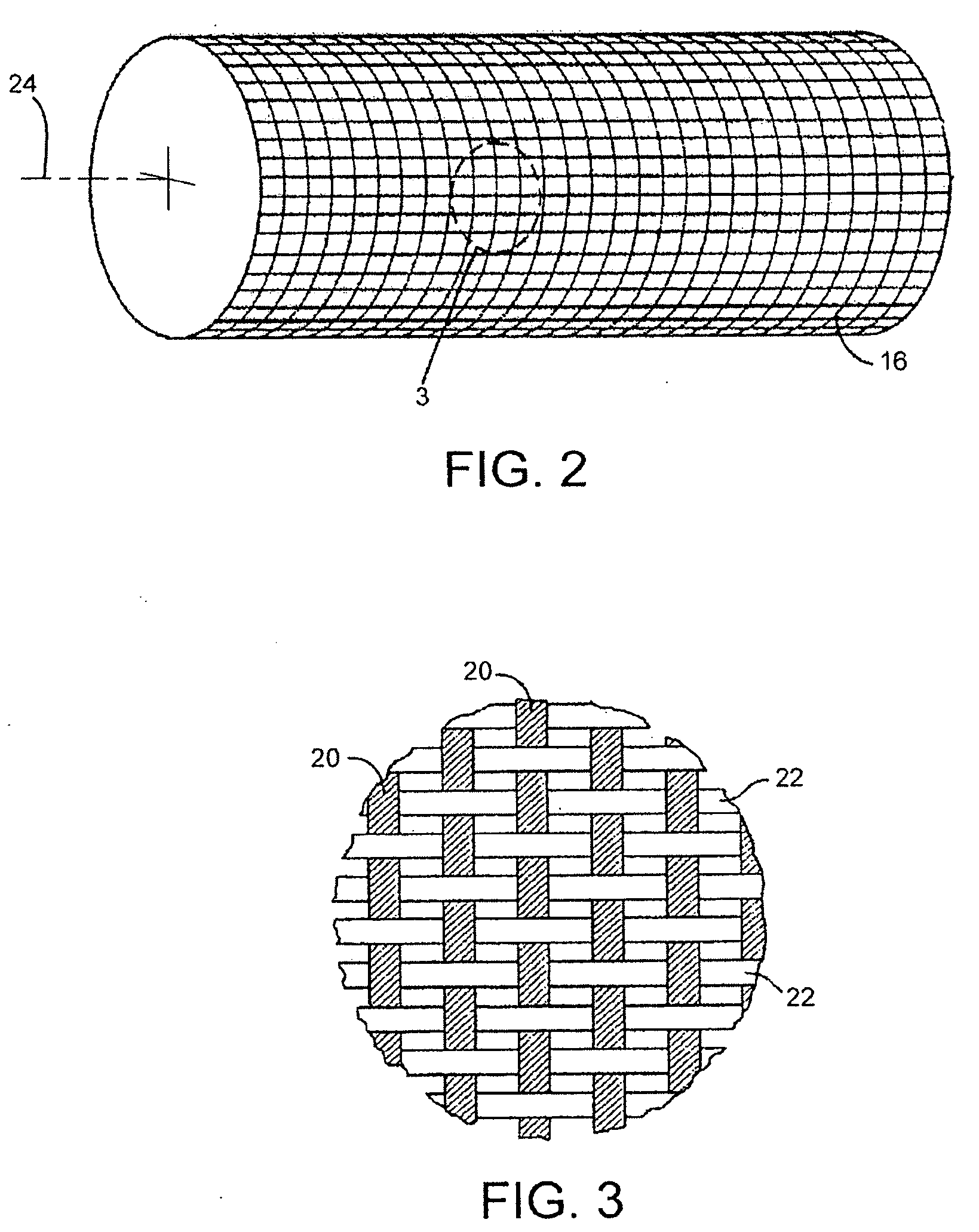 Corrugated Expansion-Constraining Sleeve for an Inflatable Penile Prosthesis Cylinder