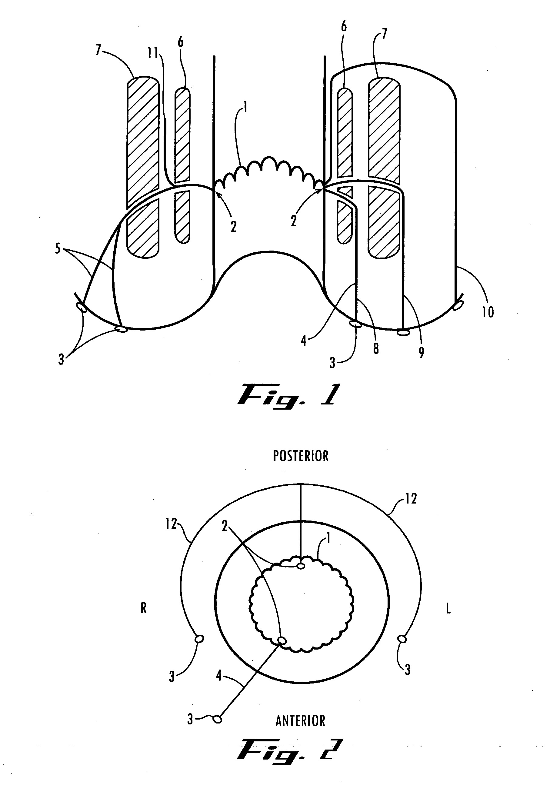 Instrument and method for endoscopic visualization and treatment of anorectal fistula