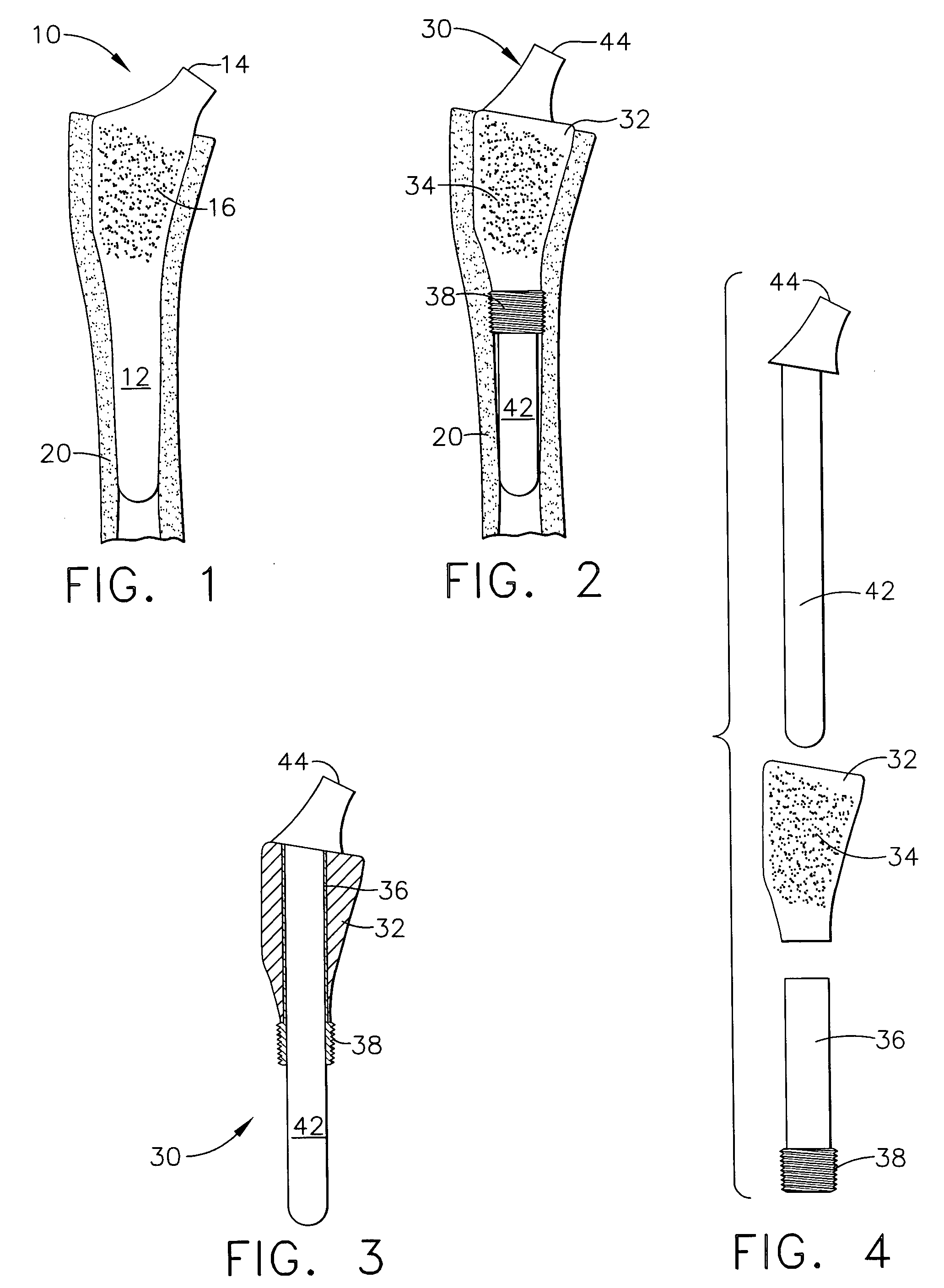 Artificial disc replacements with deployable fixation components