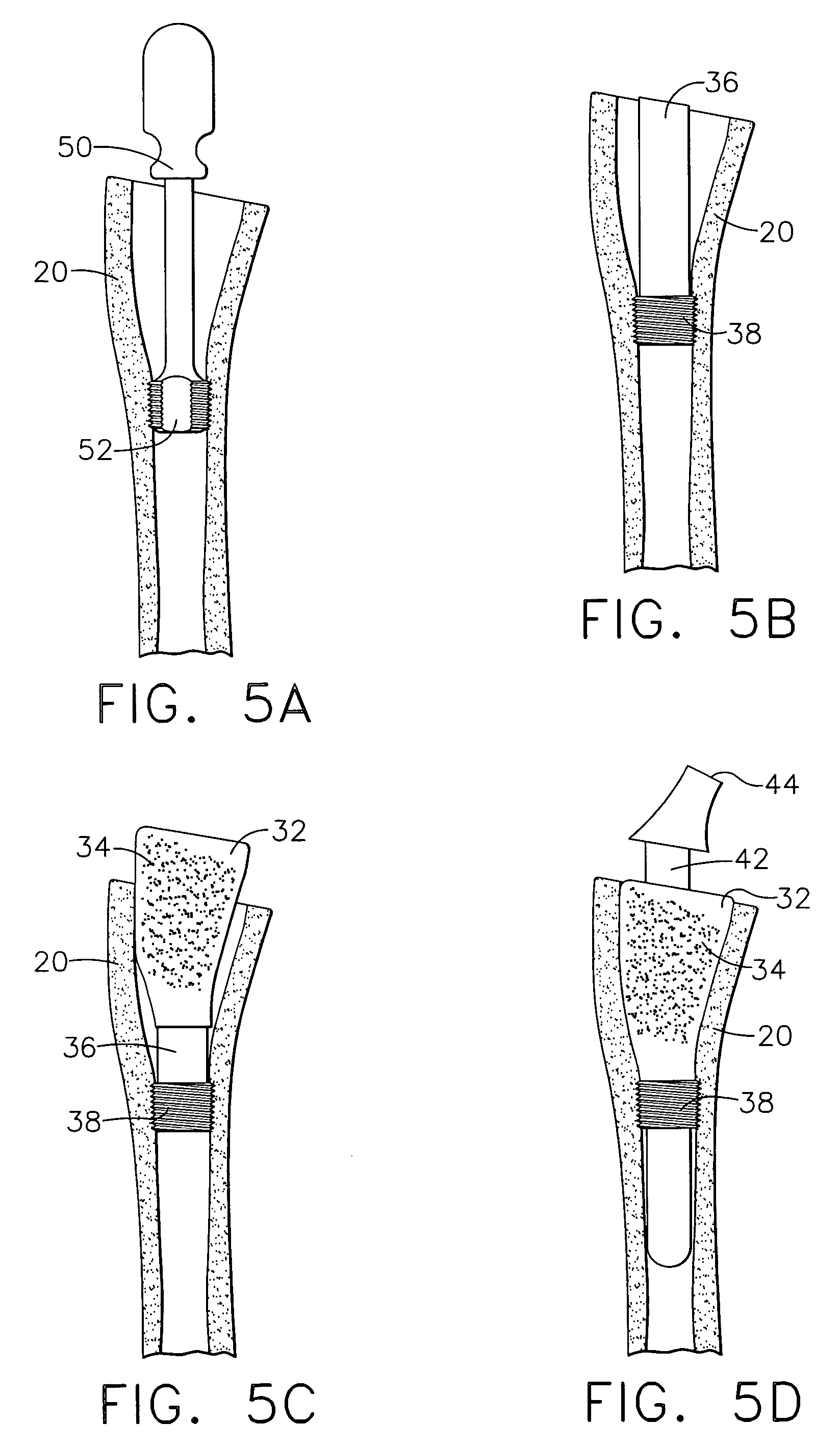 Artificial disc replacements with deployable fixation components