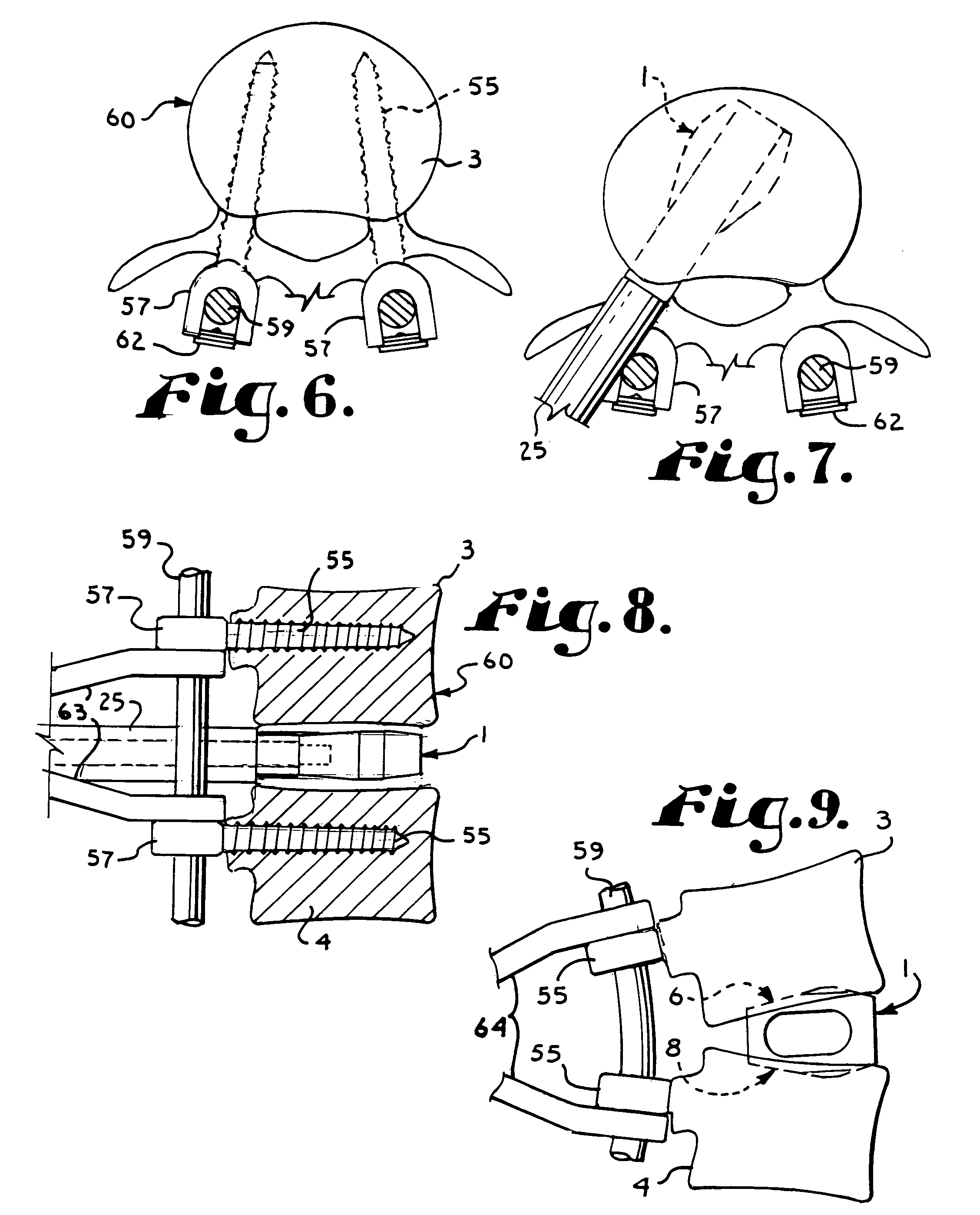 Convex spinal fusion interbody spacer