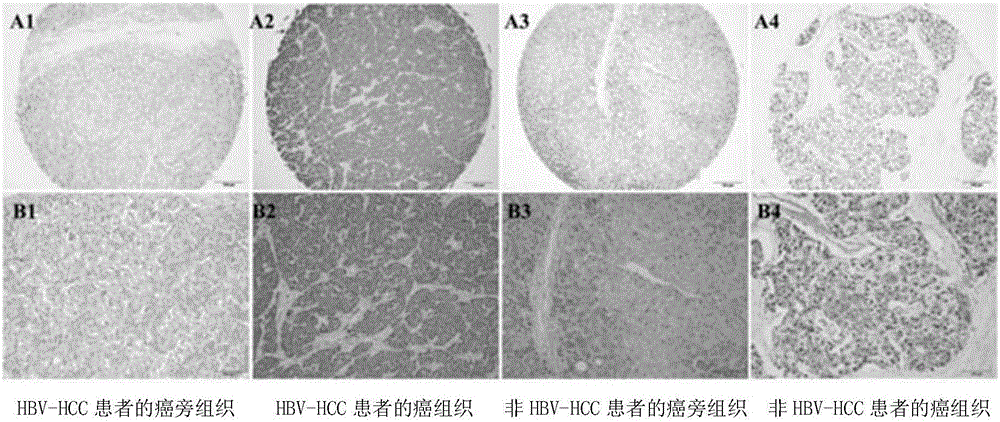 Novel use of adipogenic differentiation-associated proteins as screening markers for HBV-HCC patients