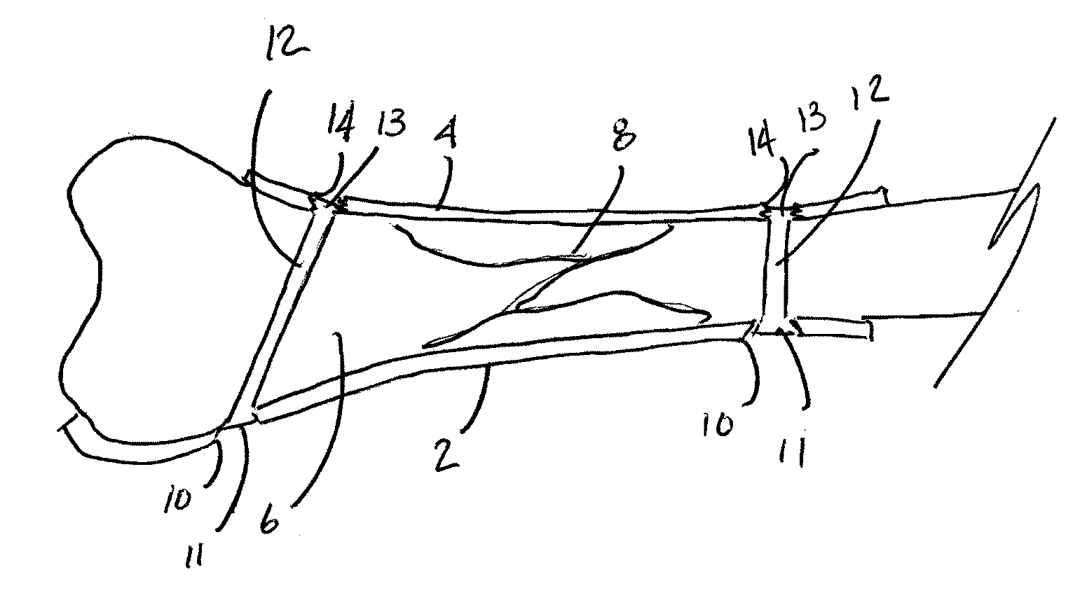 System for making a bone repair