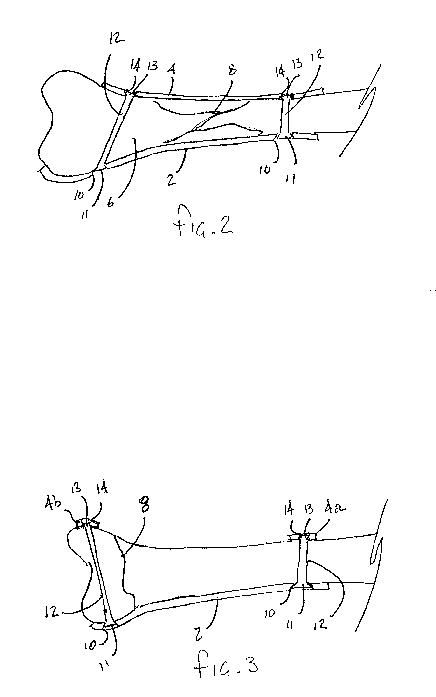 System for making a bone repair