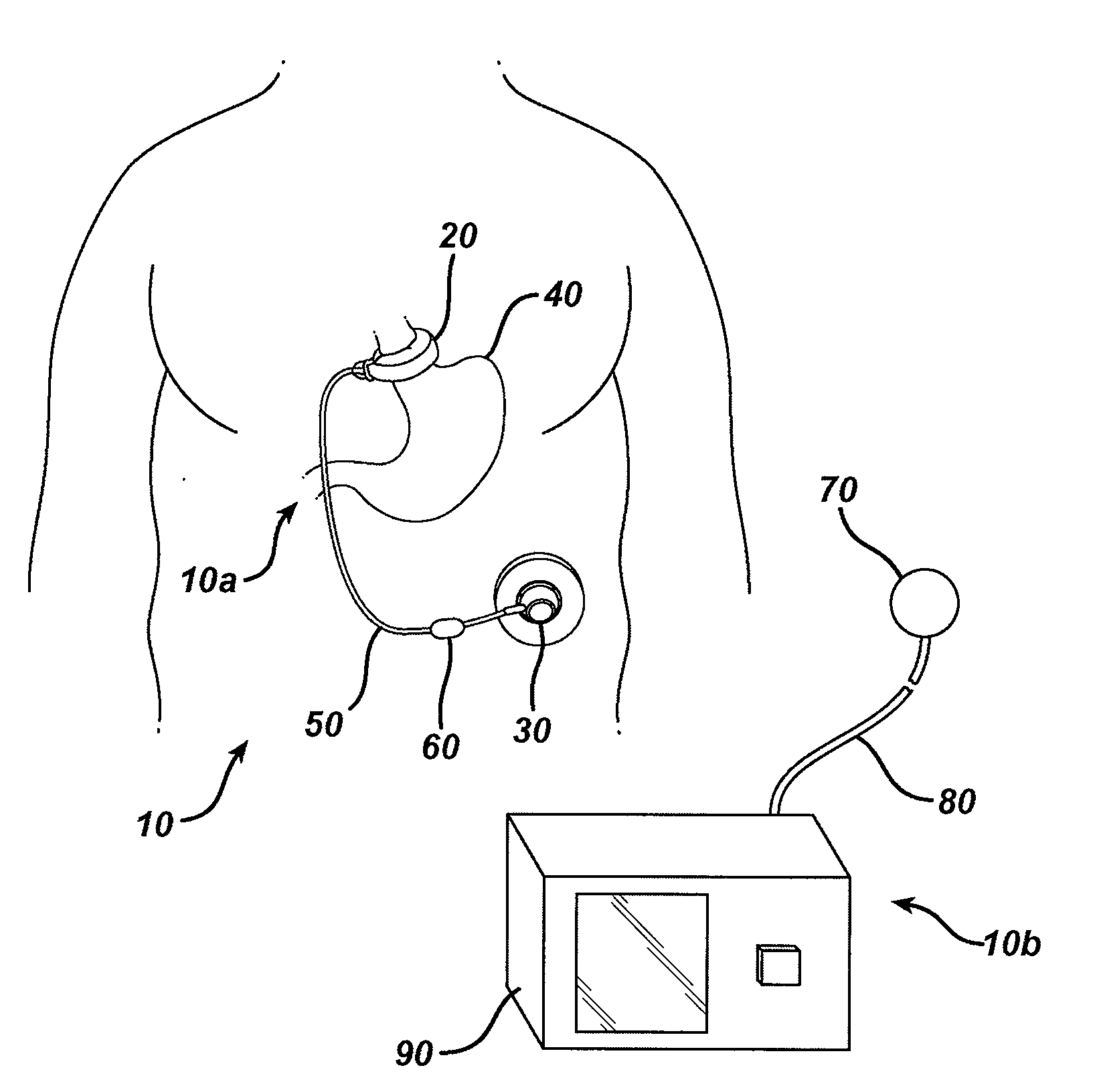 Methods and devices for measuring impedance in a gastric restriction system