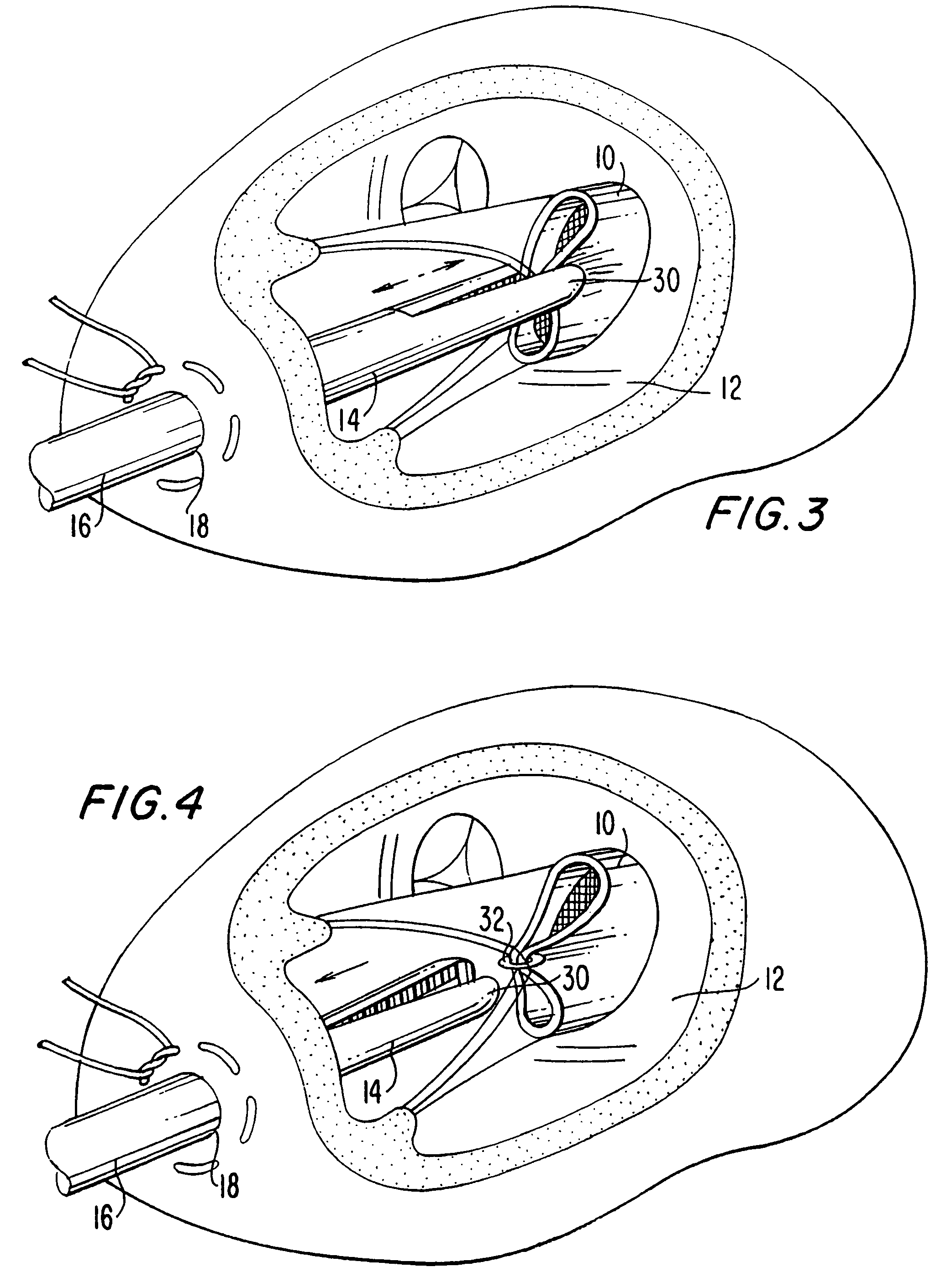 Method and apparatus for circulatory valve repair