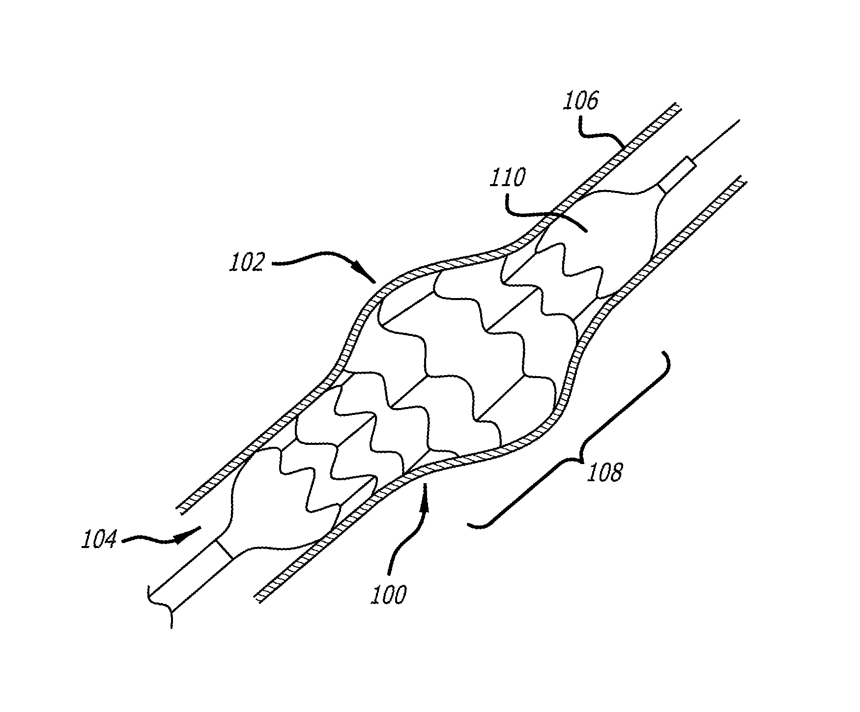 Method of fabricating an intraluminal scaffold with an enlarged portion