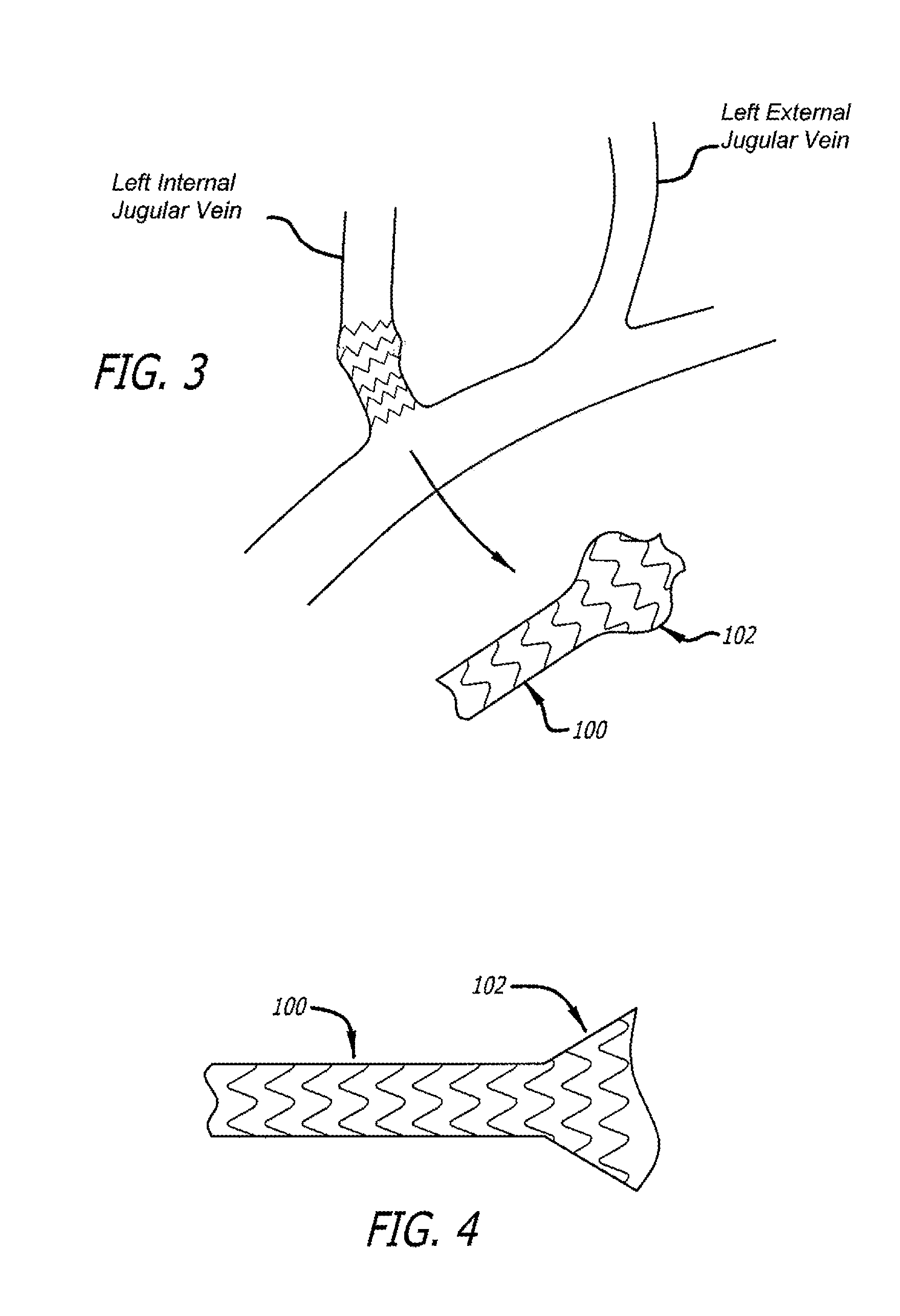 Method of fabricating an intraluminal scaffold with an enlarged portion