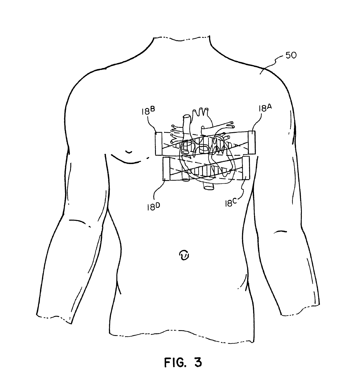 System and method employing interferential electrical stimulation to treat cardiac issues