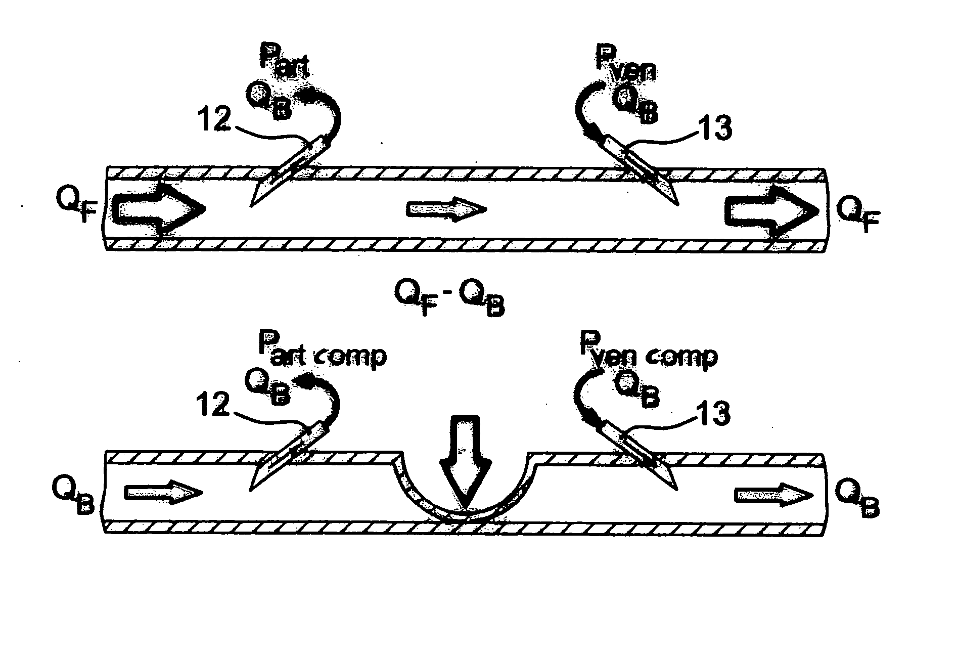 Method and device for determining blood flow in a vascular access