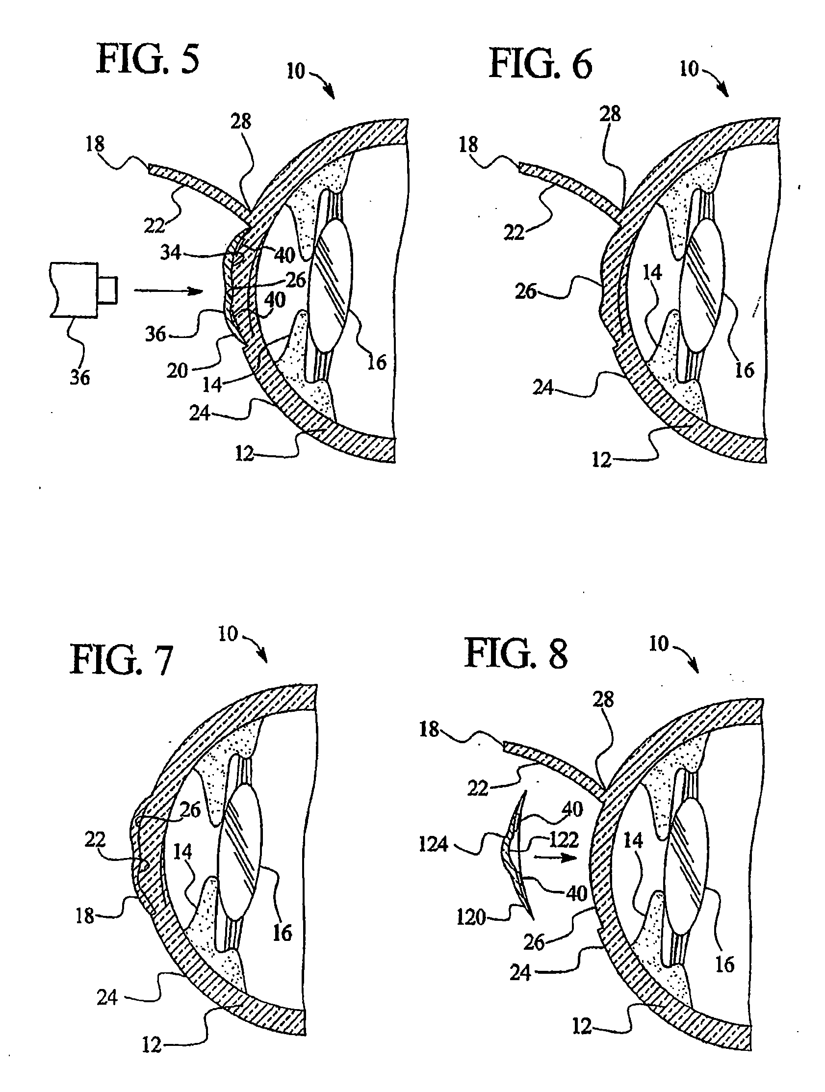 Method of treating the eye using controlled heat delivery