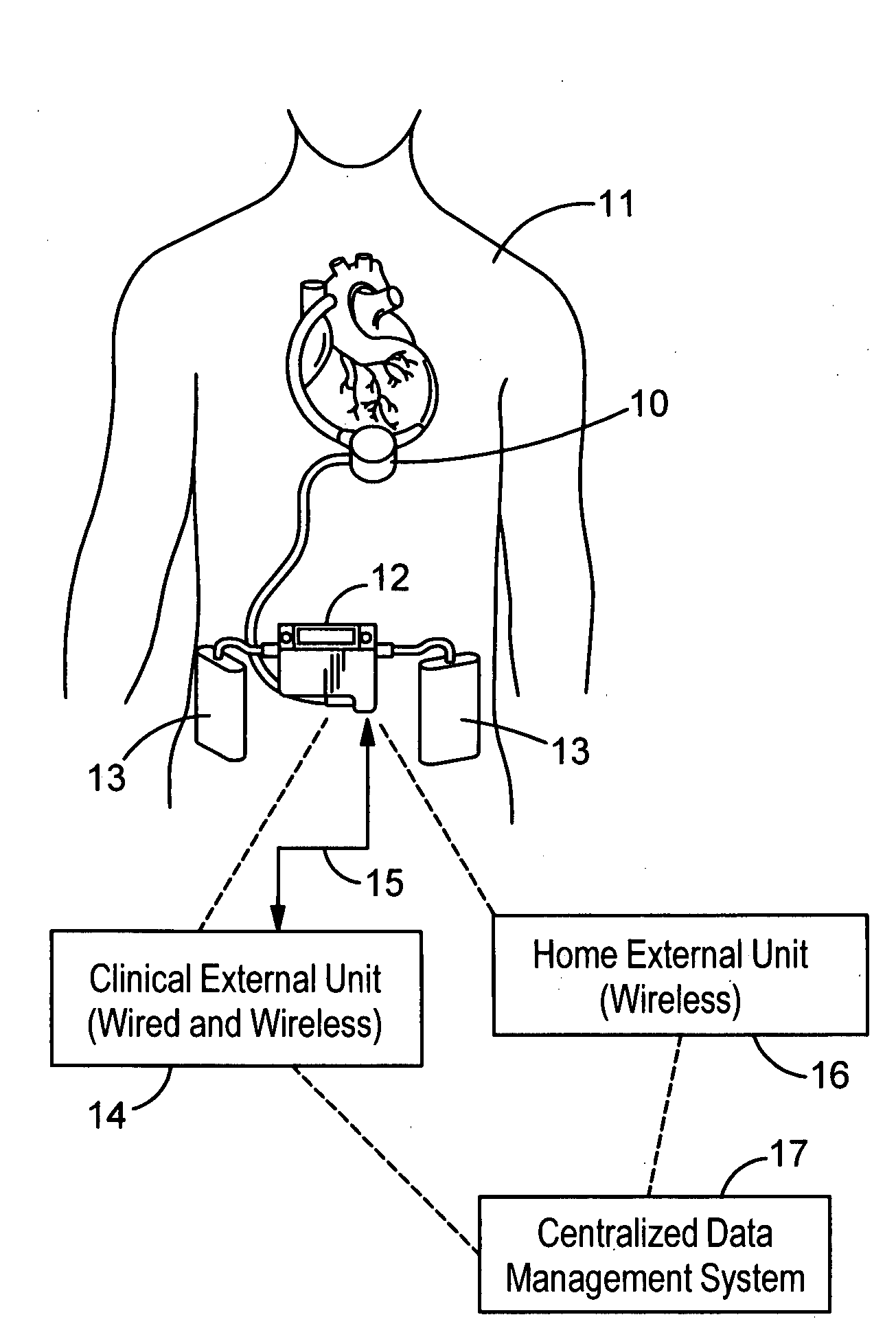 Dual communication interface for artificial heart system