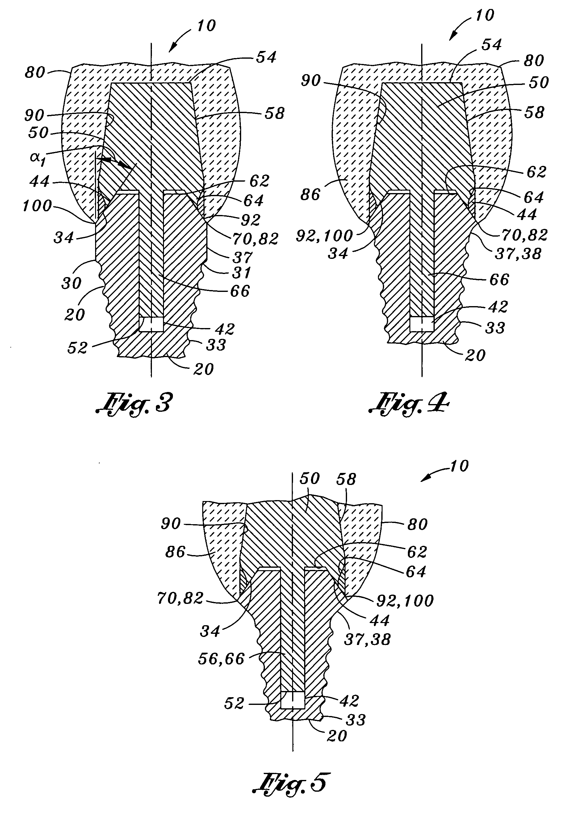 Dental implant