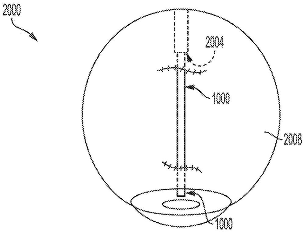 Ocular drainage system devices and methods