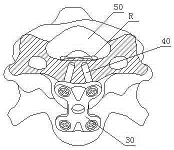 Anterior cervical pedicle screw plate fixing system