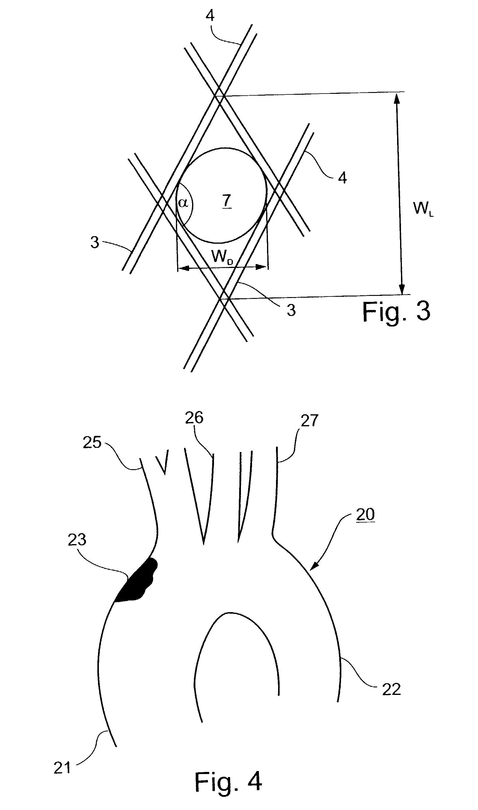 Implantable intraluminal protector device and method of using same for stabilizing atheromas