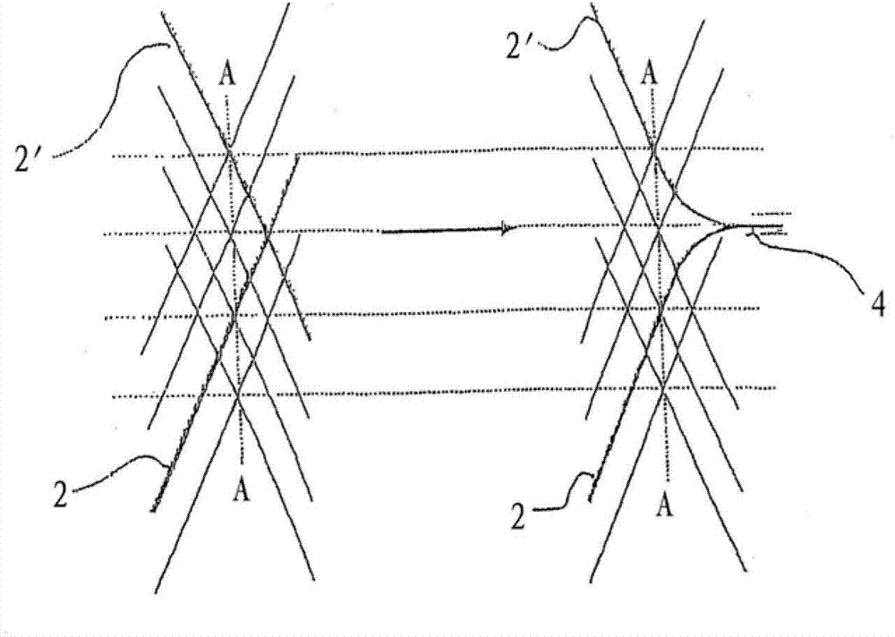 Implant for influencing the blood flow in arteriovenous defects