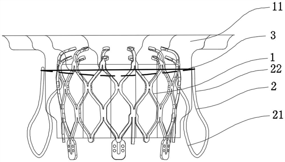 Heart valve prosthesis capable of being anchored with autologous valve leaflets