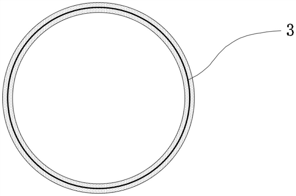 Heart valve prosthesis capable of being anchored with autologous valve leaflets