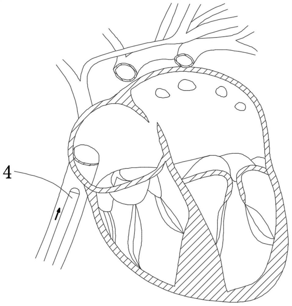 Heart valve prosthesis capable of being anchored with autologous valve leaflets