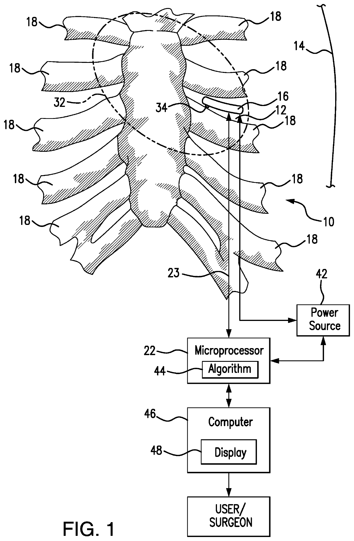 Pacemaker system equipped with a flexible intercostal generator