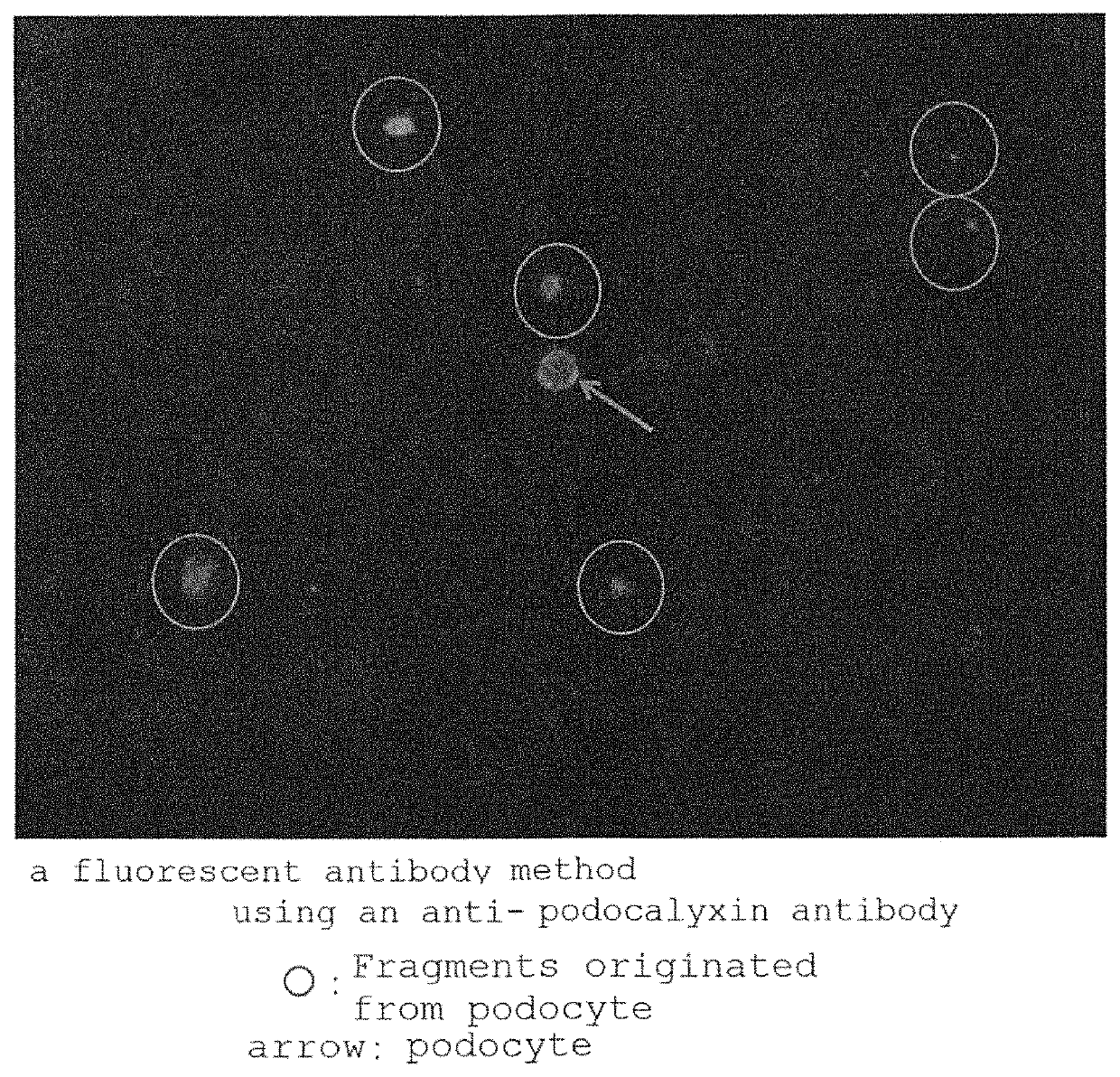 Method for estimating number of podocytes in urine