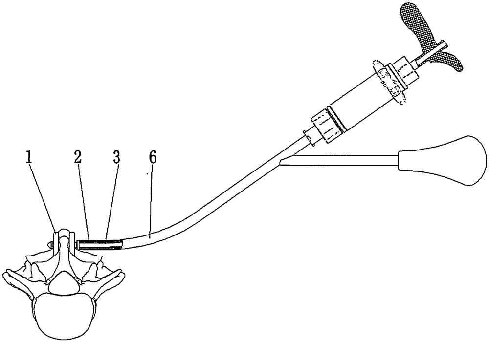 Novel interspinous fixing sleeve piece and usage method thereof