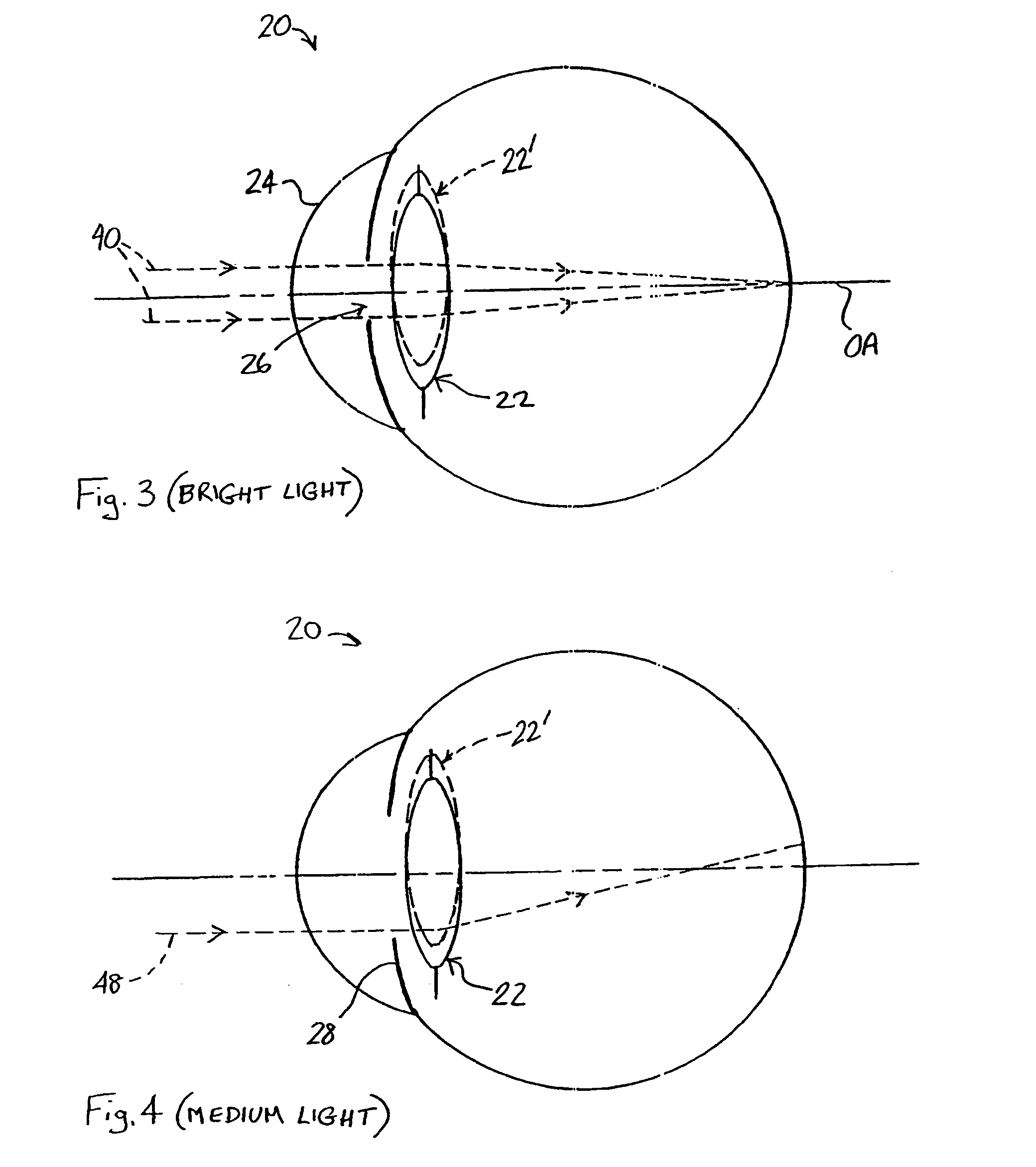 Multi-zonal monofocal intraocular lens for correcting optical aberrations