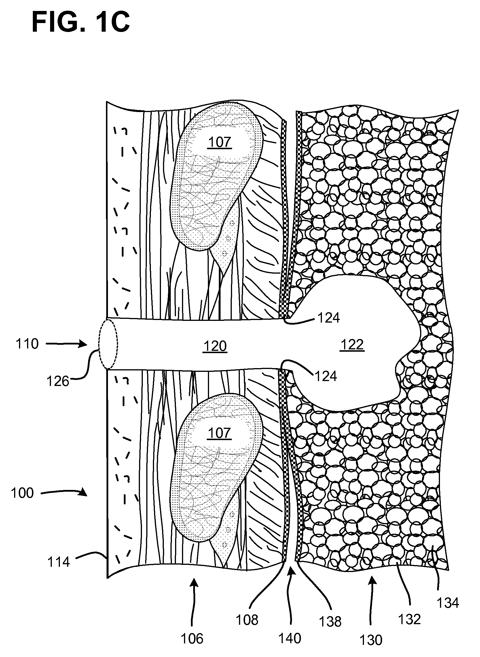 Pneumostoma management method for the treatment of chronic obstructive pulmonary disease