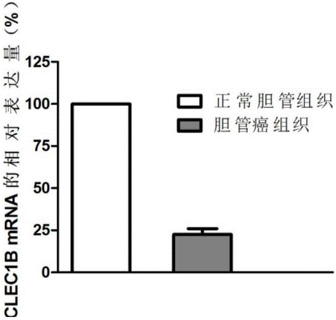 Application of CLEC1B (C-type lectin domain family 1 member B) genes on diagnosis and treatment of bile duct carcinoma