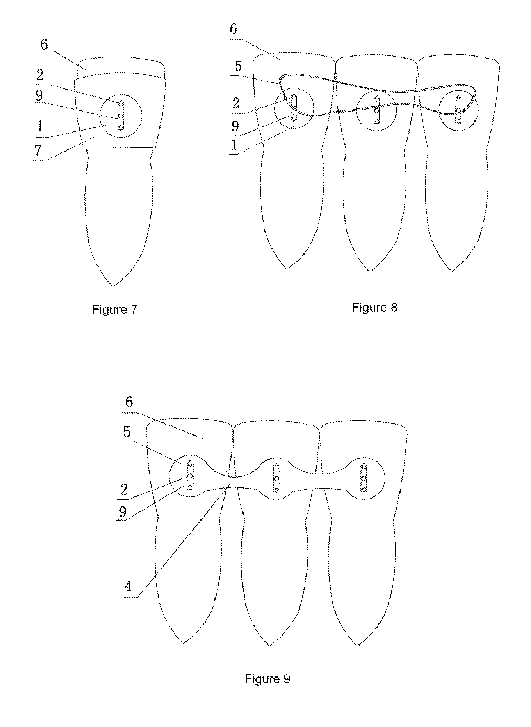 Orthodontic functional appliance