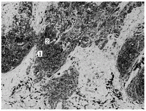 Immunohistochemical hematoxylin-toluidine blue double-redyeing method for melanocyte