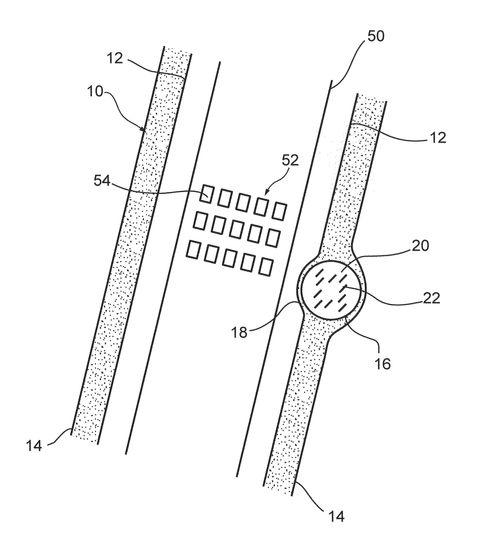 Treating weakened vessel wall such as vulnerable plaque or aneurysms