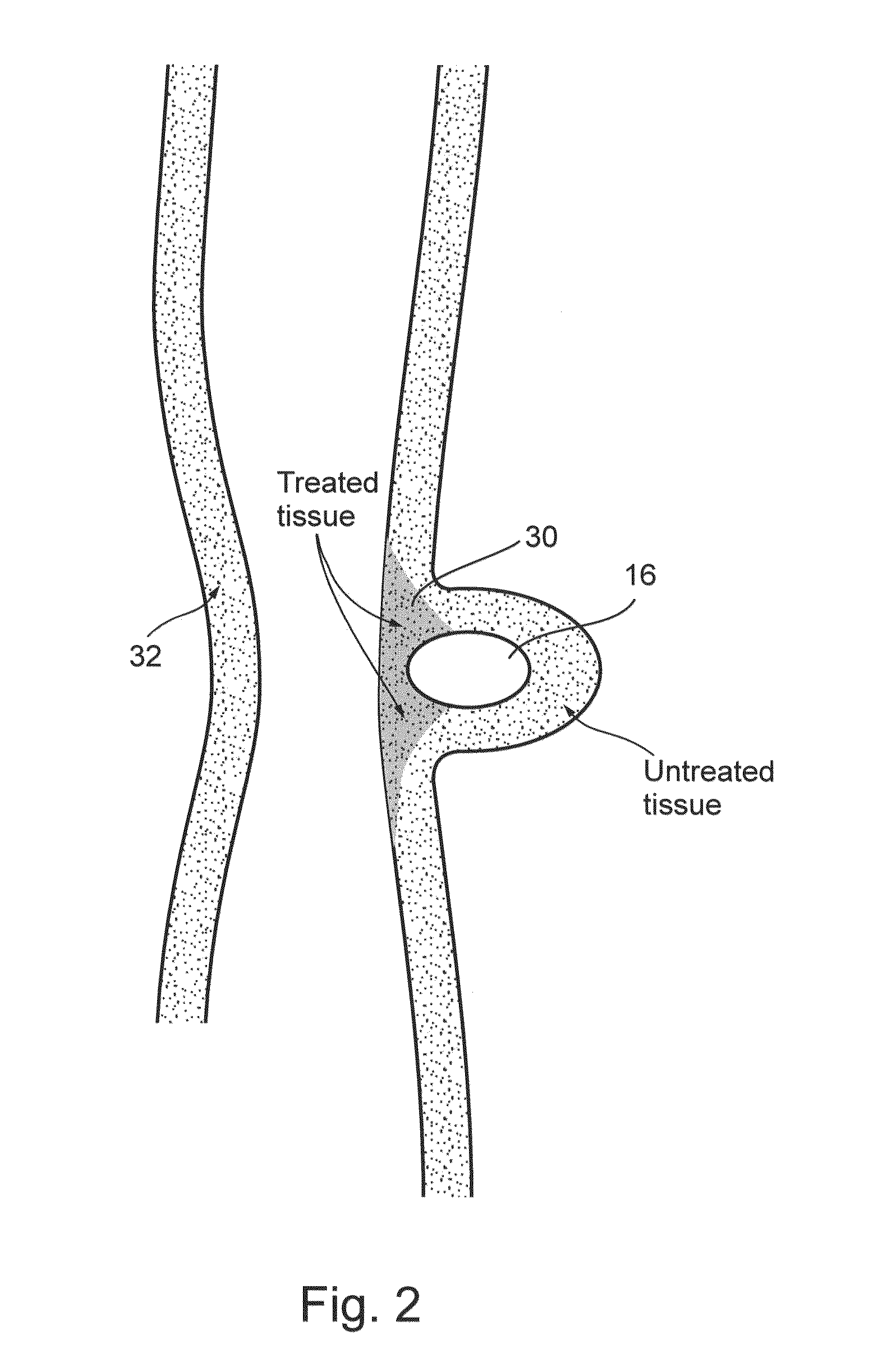 Treating weakened vessel wall such as vulnerable plaque or aneurysms