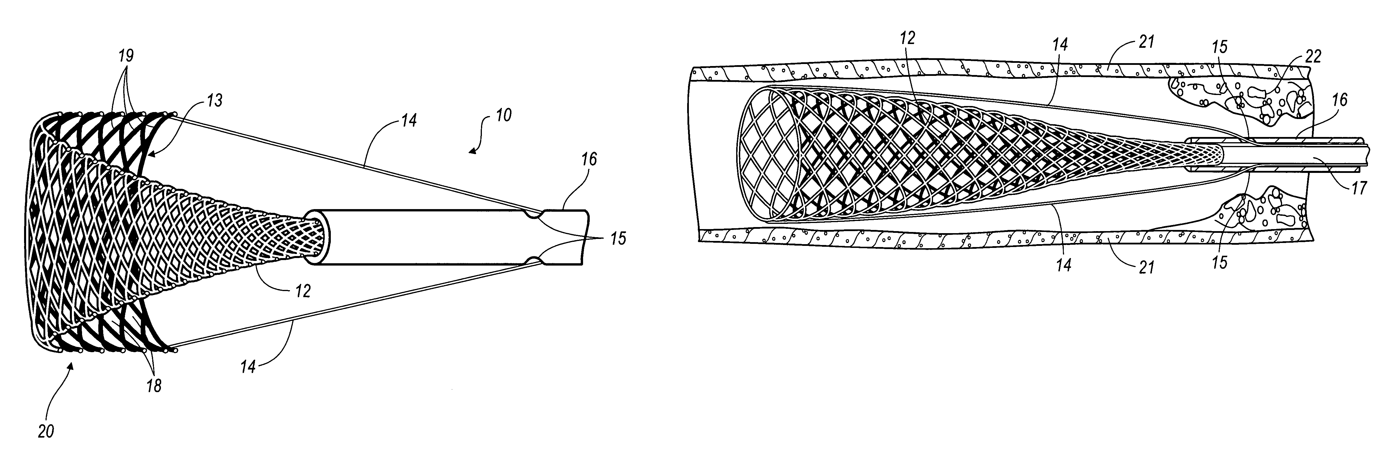 Invertible filter for embolic protection