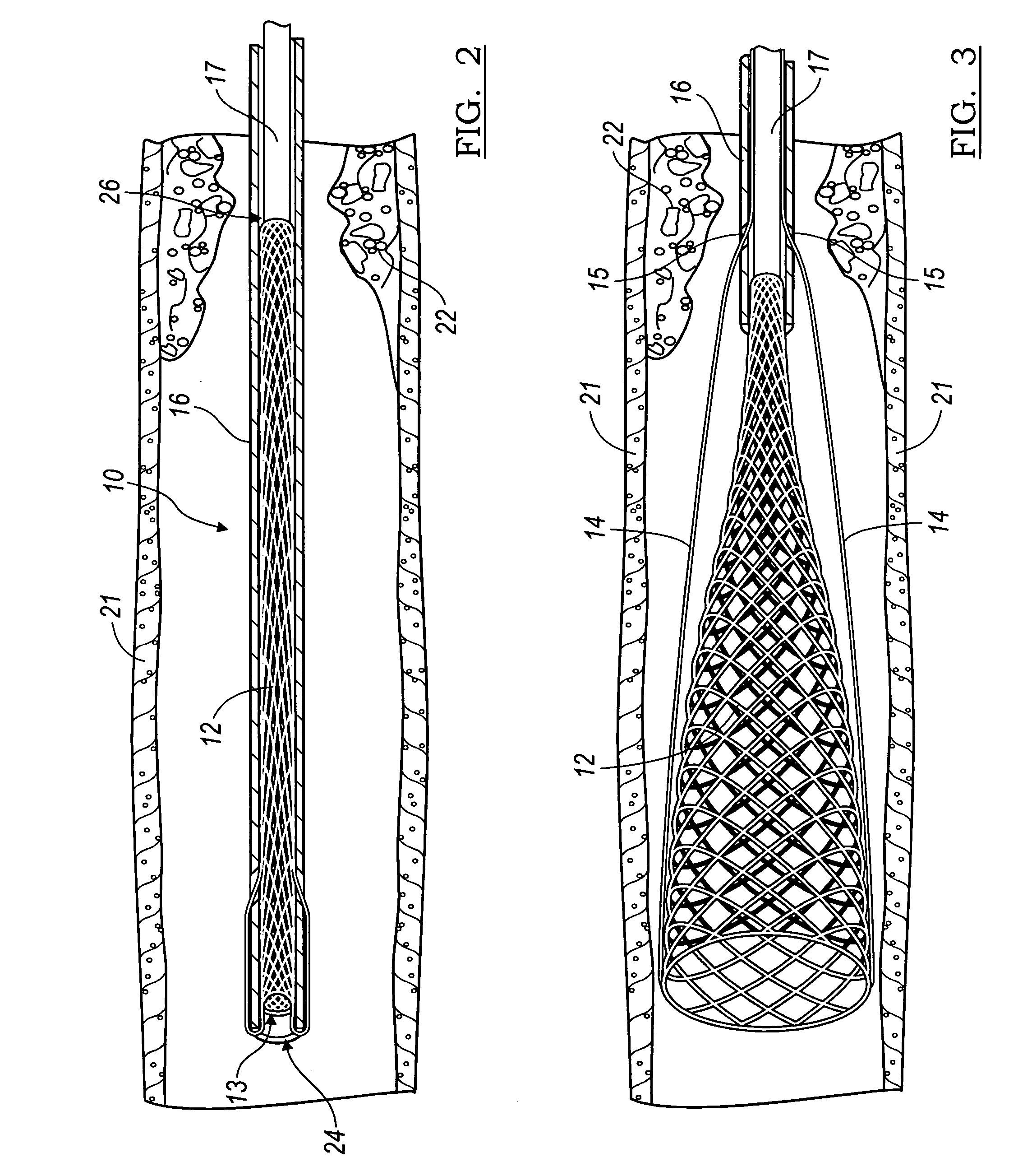 Invertible filter for embolic protection