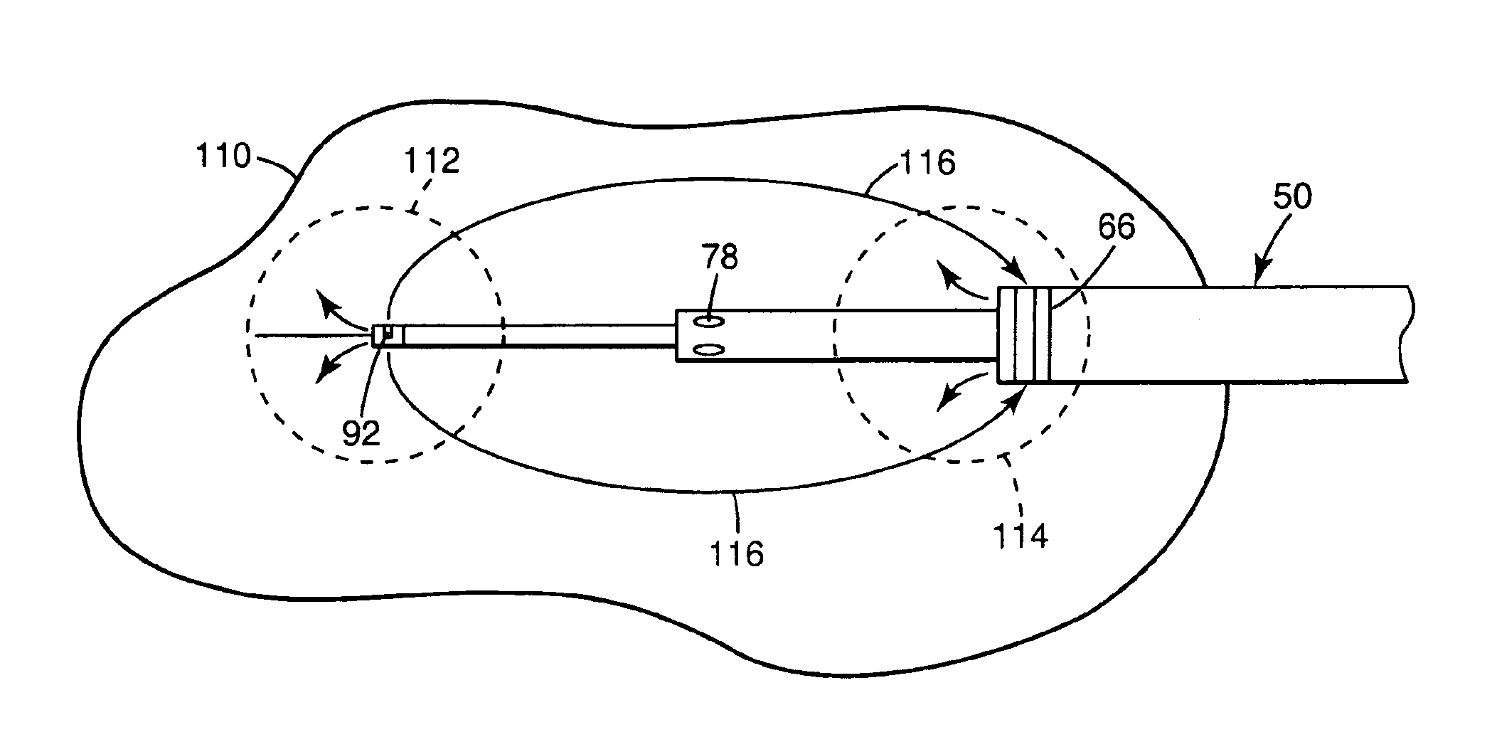 Method and apparatus for creating a bi-polar virtual electrode used for the ablation of tissue