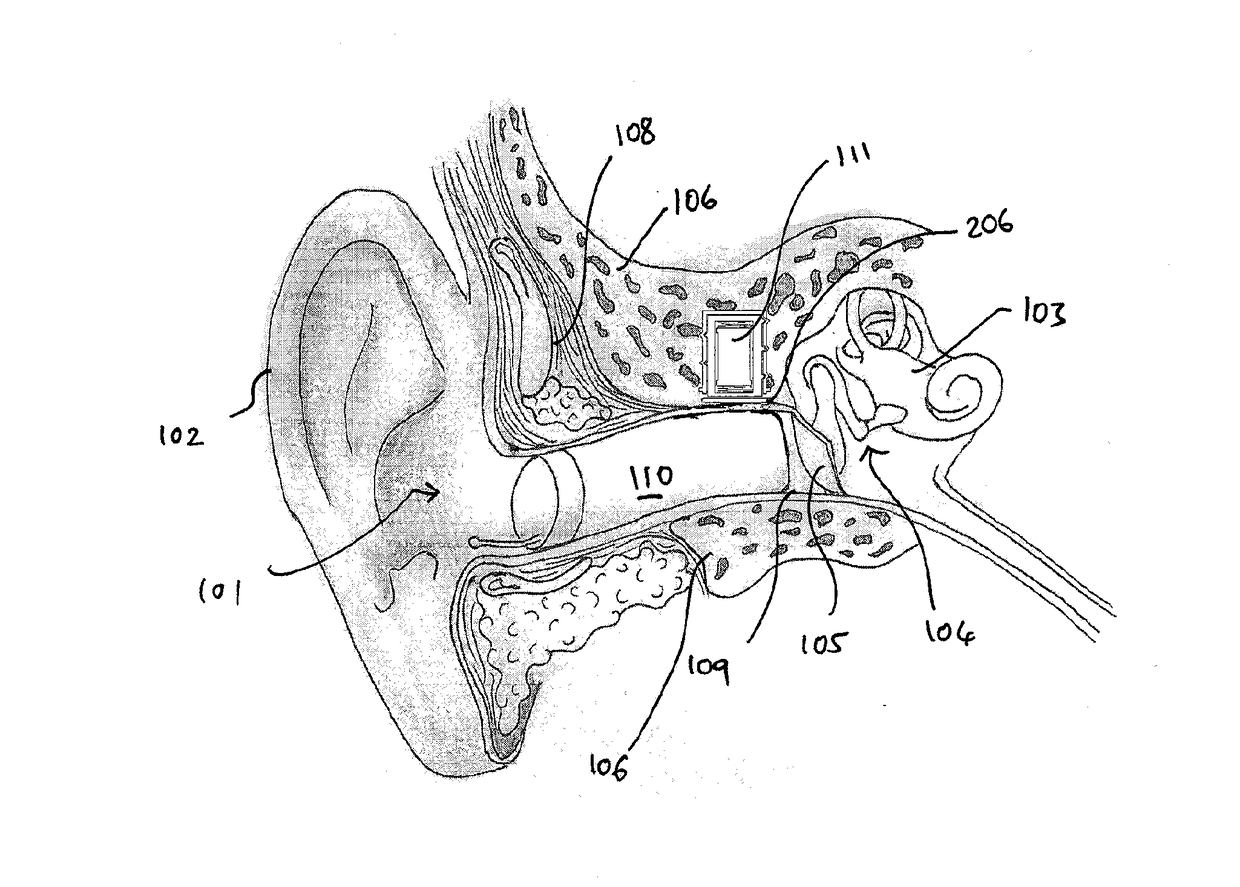 Hearing aid