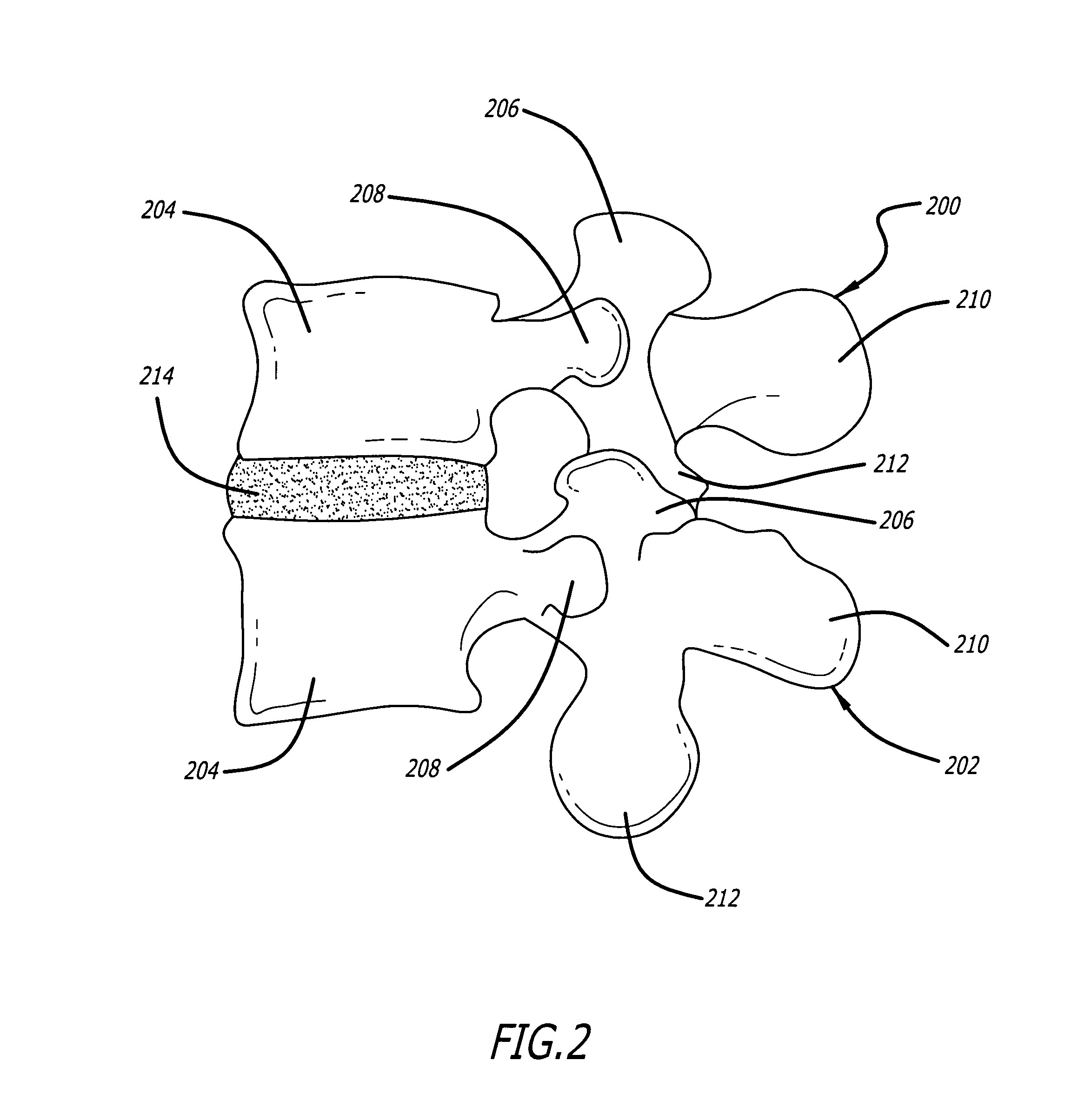 Method of deformity correction in a spine using injectable materials
