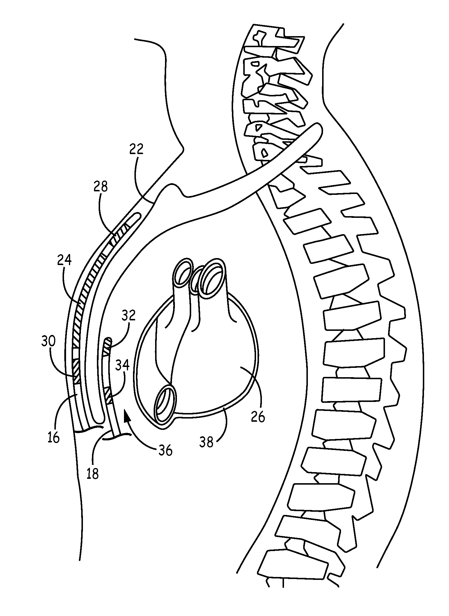 Implantable cardioverter-defibrillator (ICD) system including substernal pacing lead