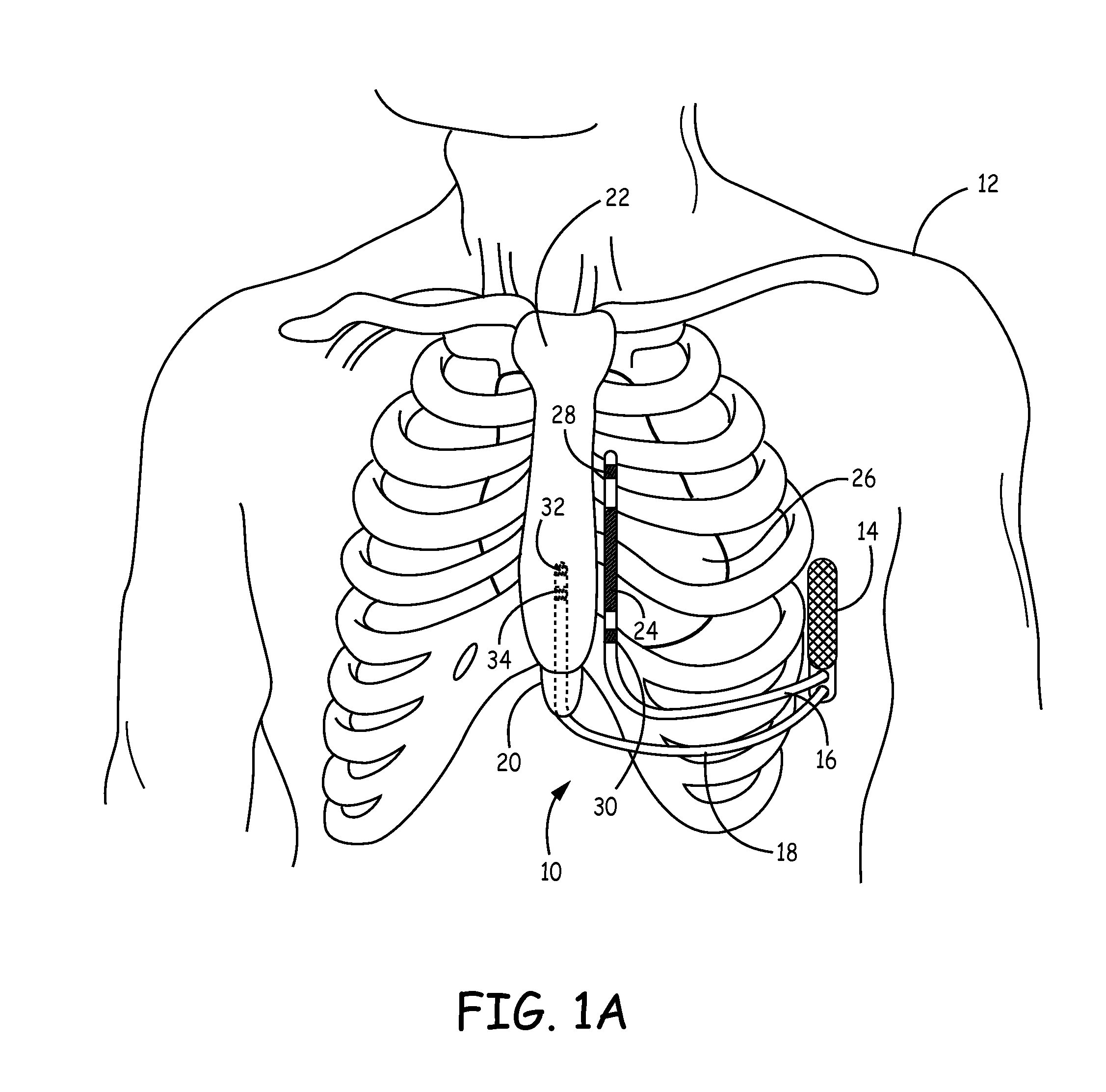 Implantable cardioverter-defibrillator (ICD) system including substernal pacing lead