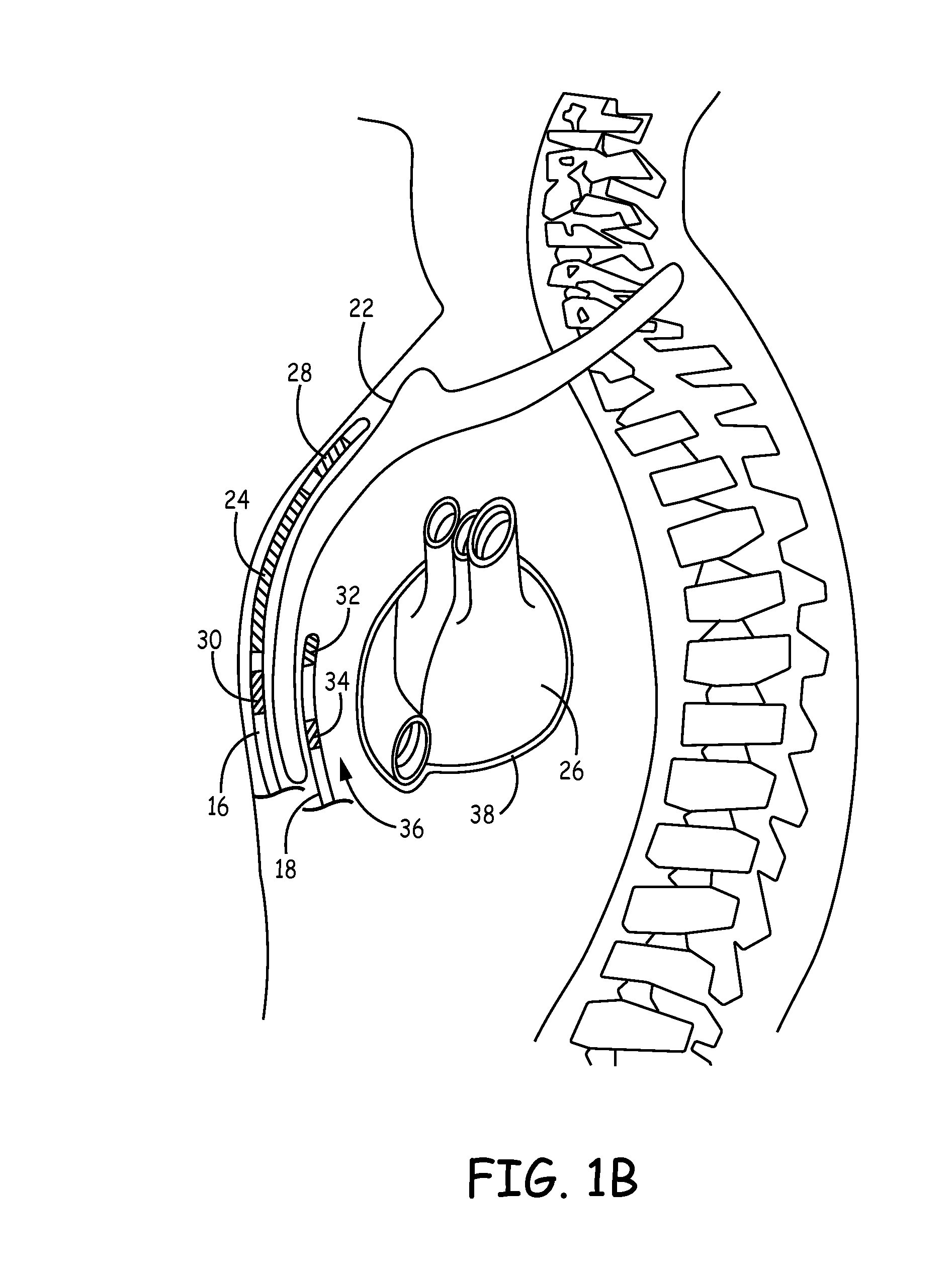 Implantable cardioverter-defibrillator (ICD) system including substernal pacing lead