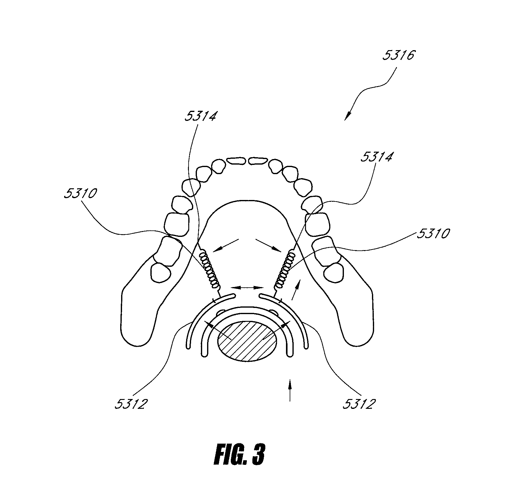 Methods and devices for the treatment of airway obstruction, sleep apnea and snoring