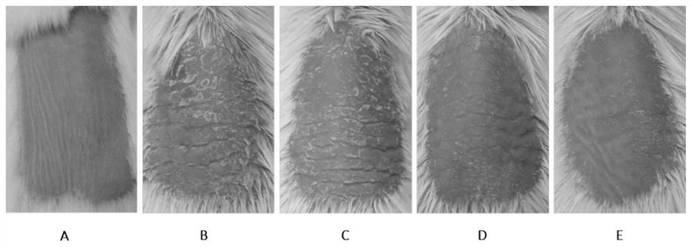 Application of Remetinostat in preparation of medicine for treating psoriasis