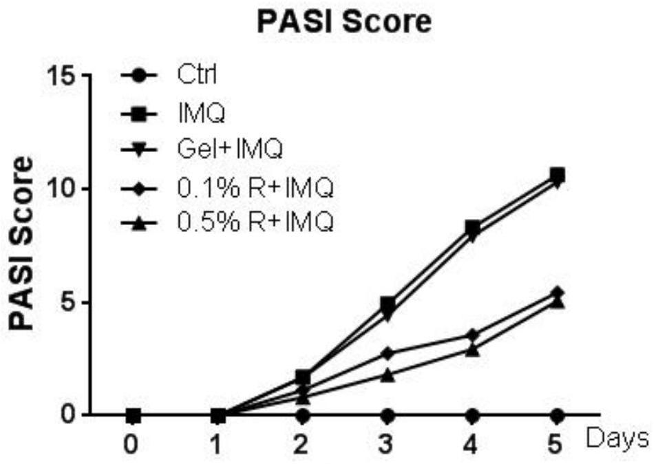 Application of Remetinostat in preparation of medicine for treating psoriasis