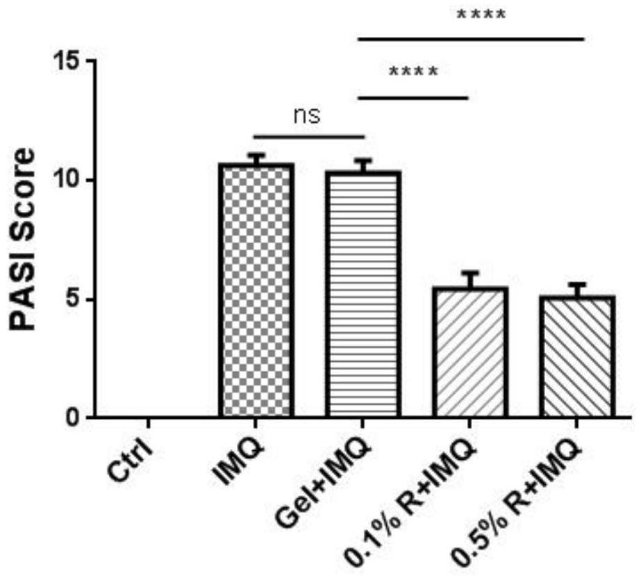 Application of Remetinostat in preparation of medicine for treating psoriasis