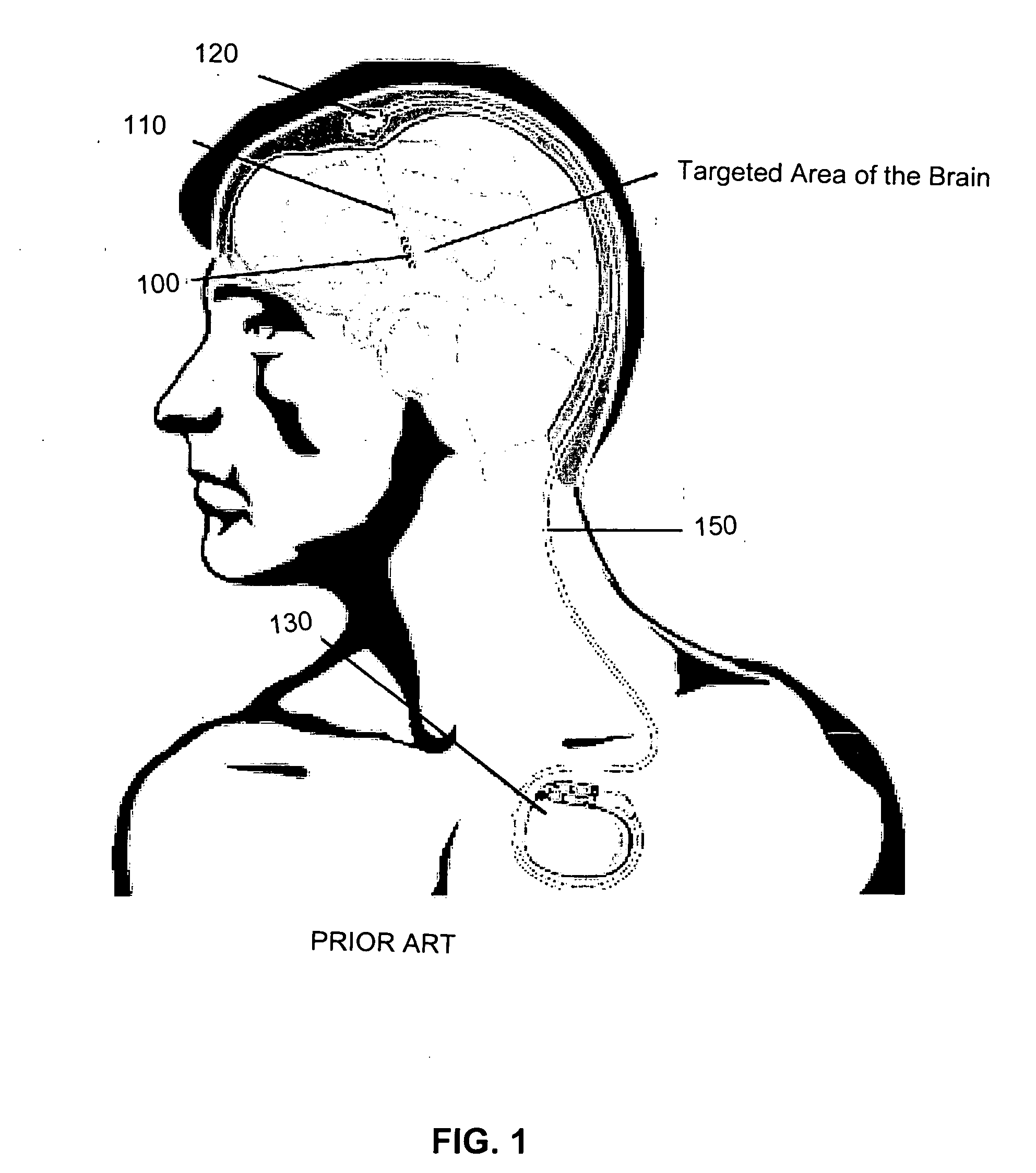 Device for brain stimulation using RF energy harvesting