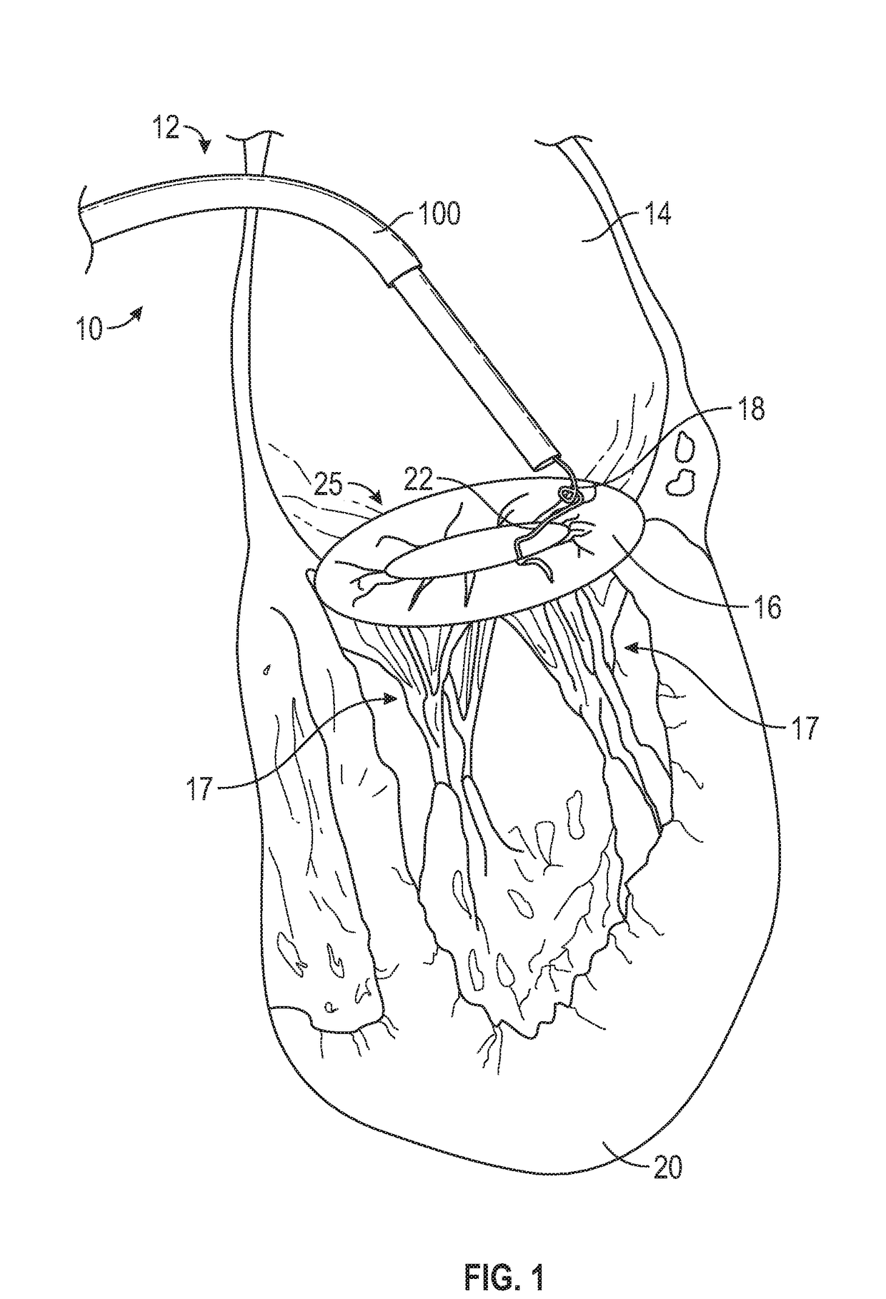 Apparatus for transvascular implantation of neo chordae tendinae