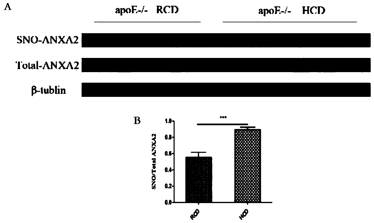 Medical use of thiol and nitrosylation modification of intervention annexin A2 (ANXA2)