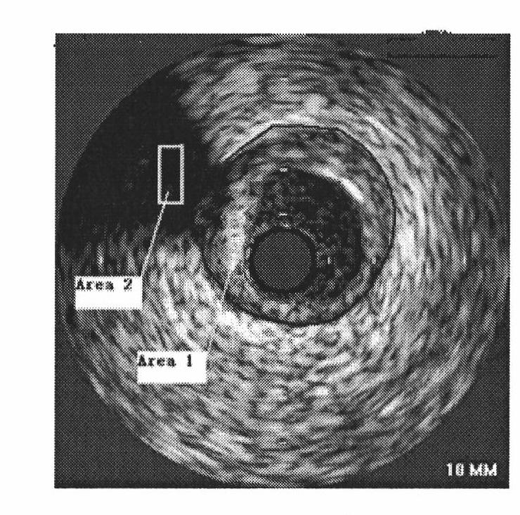 Automatic identifying method of artery plaque type based on ultrasonic image in blood vessel